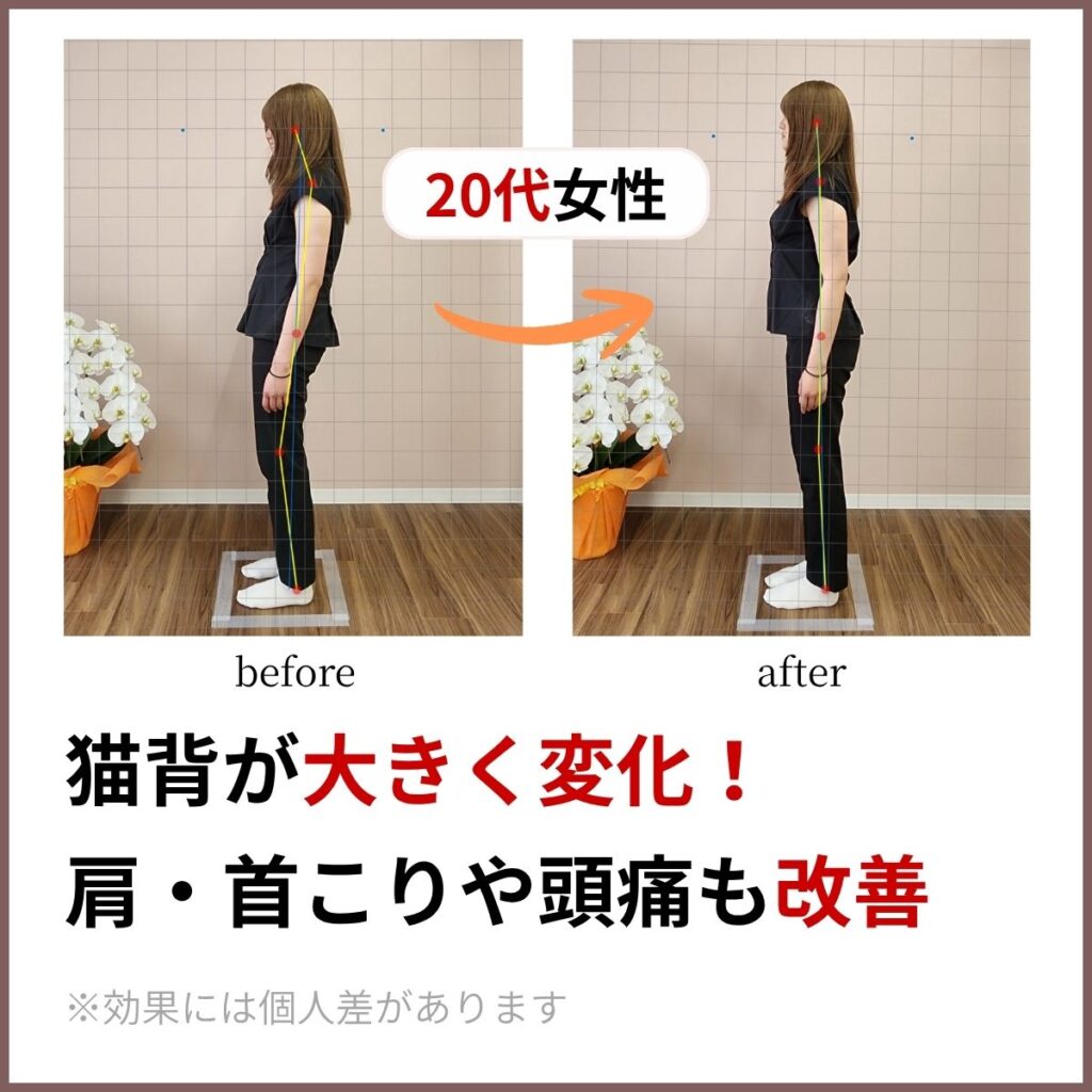 茨木あゆみ鍼灸整骨院で２０代女性が猫背、肩こり、頭痛が大きく改善したビフォーアフターの画像