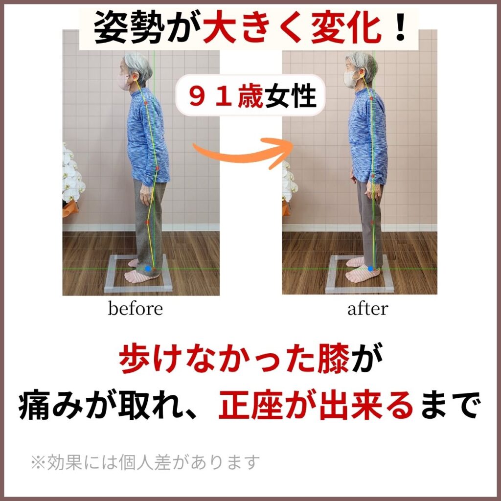 茨木あゆみ鍼灸整骨院で90代女性が膝の痛みが大きく改善したビフォーアフターの画像